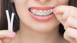 Do braces change your face shape