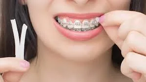 Do Braces Change Your Face Shape? Jawline, Lips and Facial Changes Explained